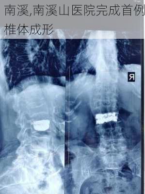 南溪,南溪山医院完成首例椎体成形